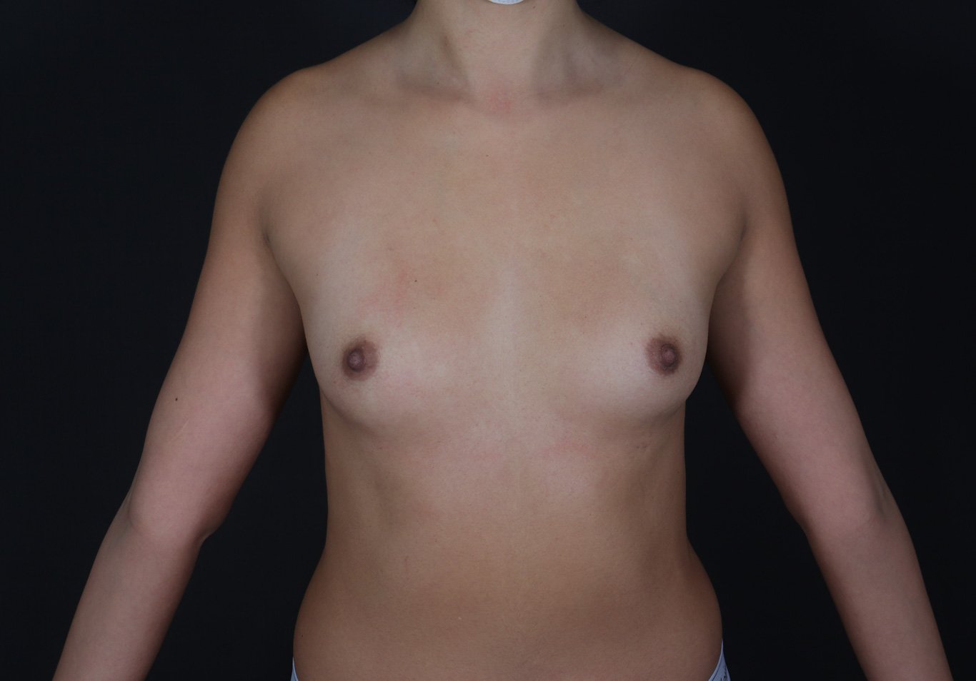 Mamoplastia de Aumento Dr Zamir Paez Cirujano Plastico