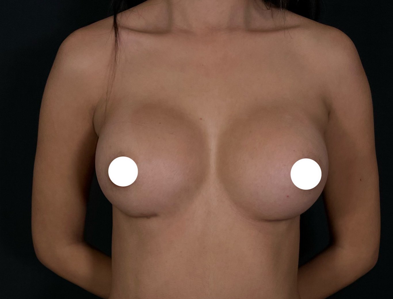 Mamoplastia de Aumento Dr Zamir Paez Cirujano Plastico