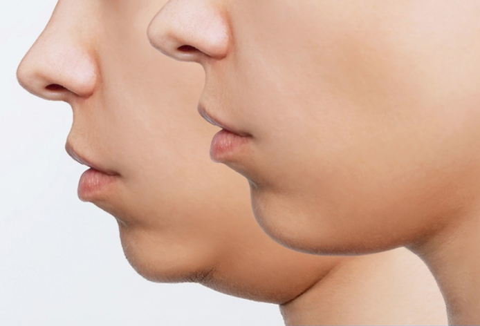 double chin liposuction colombia