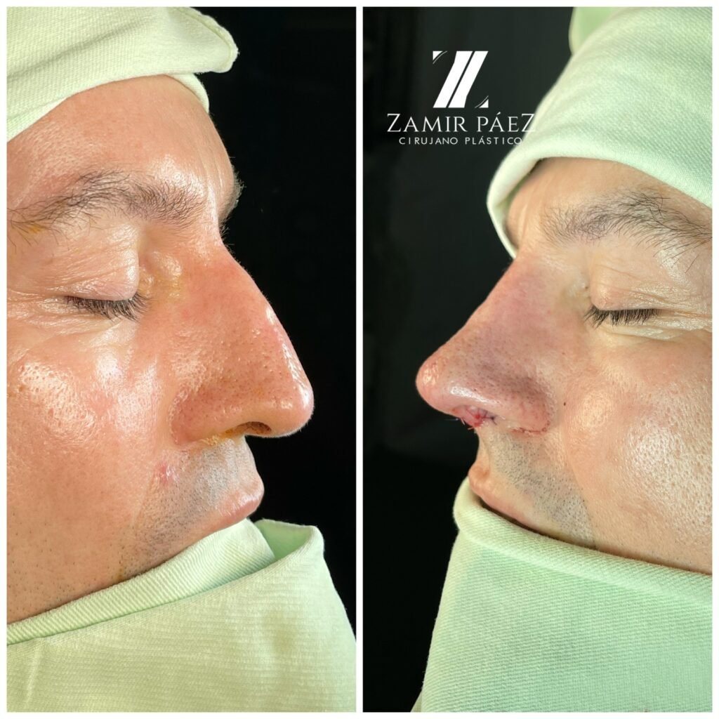 rhinoplasty for men before and after