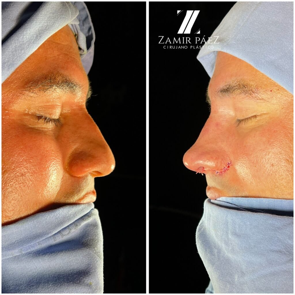 nose job before and after 1
