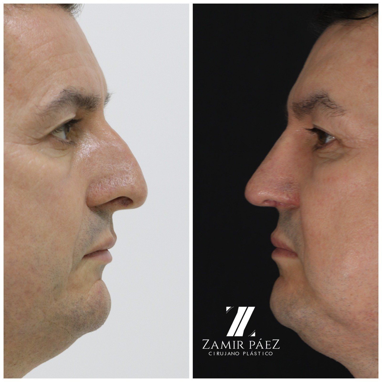 rinoplastia para hombres