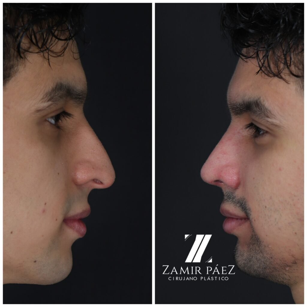rhinoplasty for men
