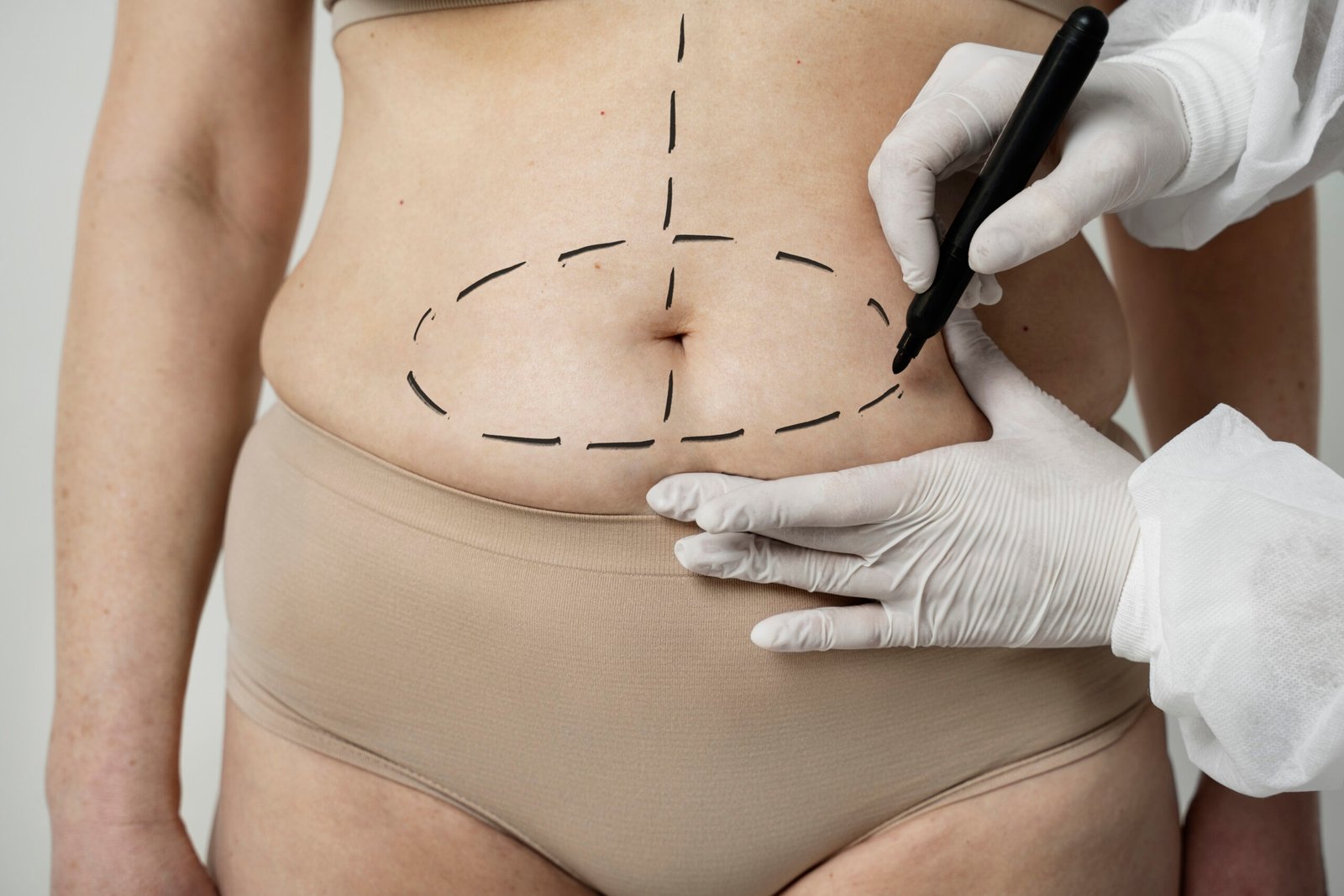 liposuction myths