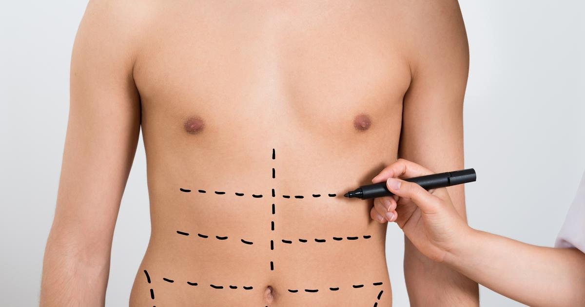 rib reshaping for body feminization in Colombia