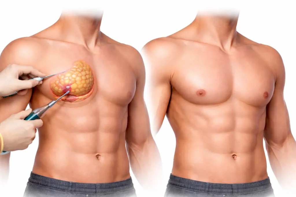 cirugía de ginecomastia en Colombia con cicatrices mínimas y contorno del pecho masculine